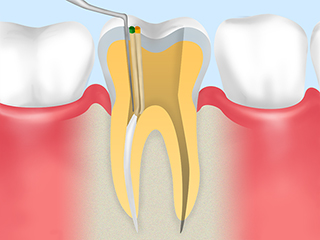 進行した虫歯の治療法～根管治療～
